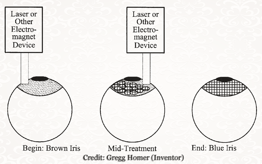 New Laser Surgery Lets You Change Eye Color from Brown to Blue in Only ...