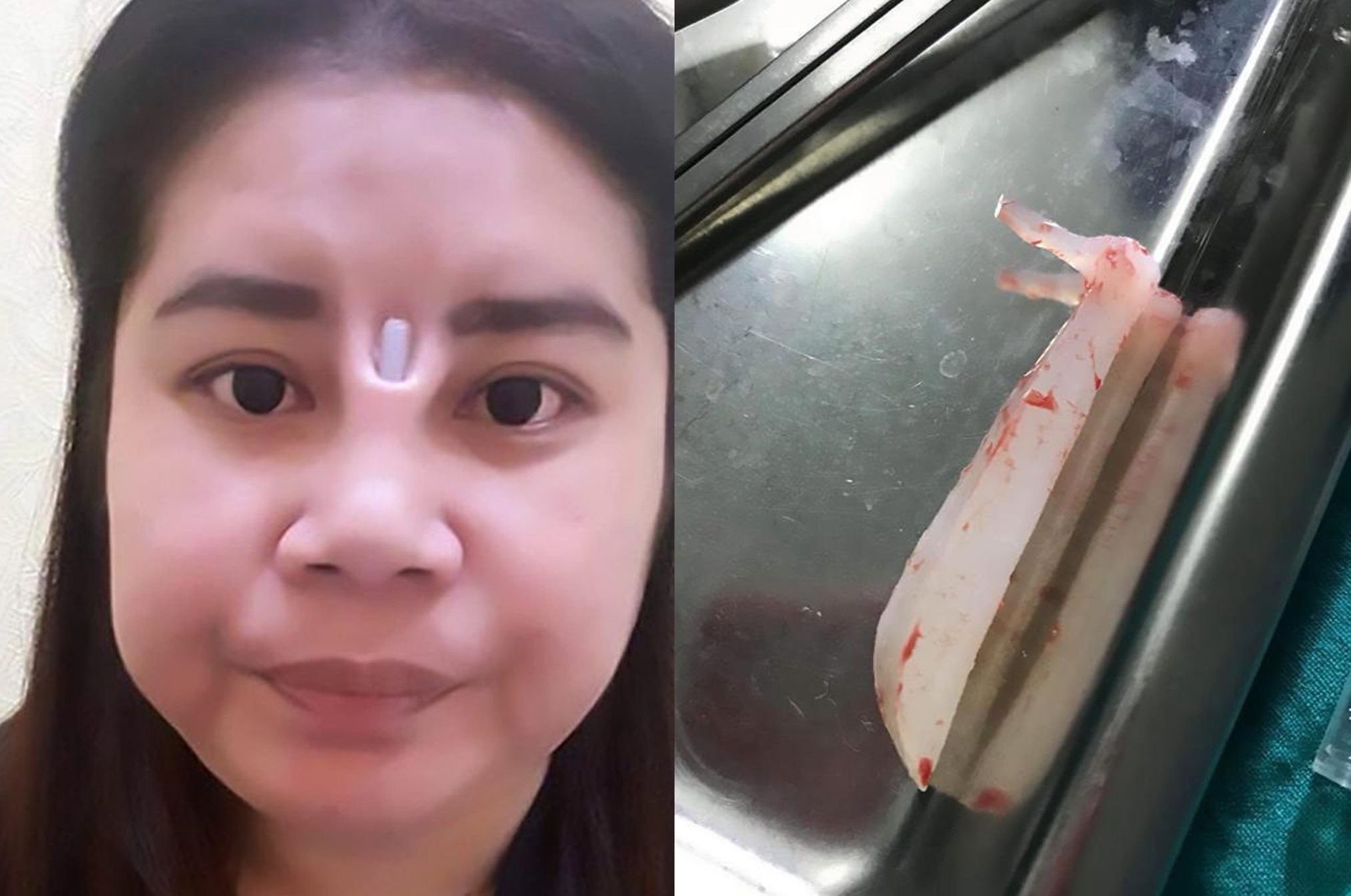 Botched Plastic Surgery Leaves Woman with Protruding Silicone Implant ...