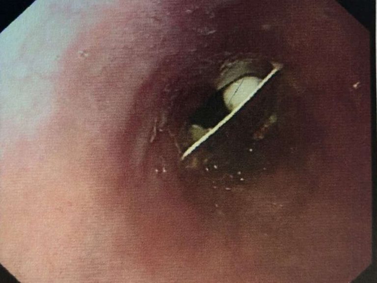 Woman Lives With Plastic Pill Packaging Lodged in Her Throat for 17 Days