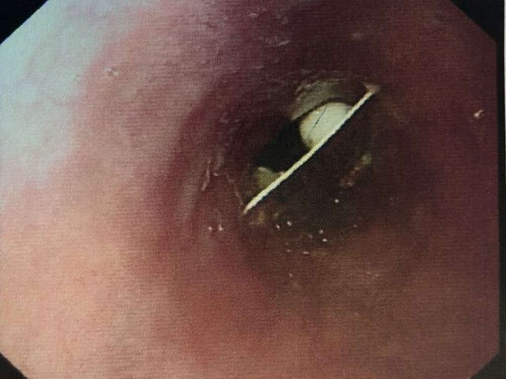 Woman Lives With Plastic Pill Packaging Lodged in Her Throat for 17 Days