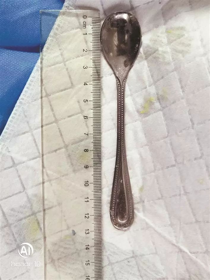 Woman accidentally swallows a five inch metal spoon down throat