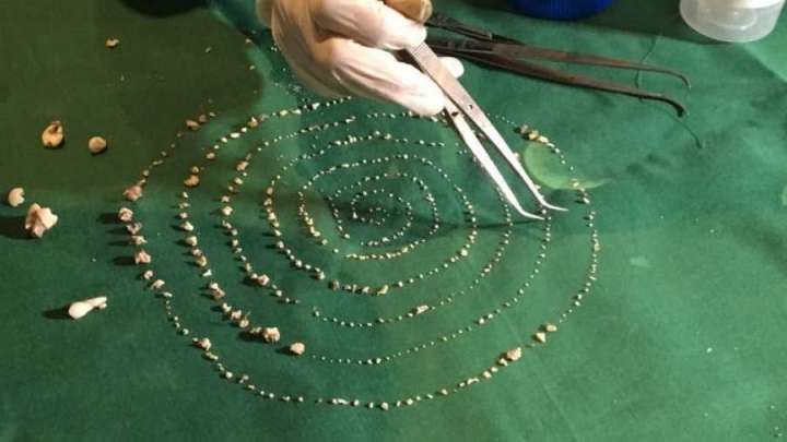 Doctors Pull Over 500 Teeth from 7-Year-Old Boy's Mouth