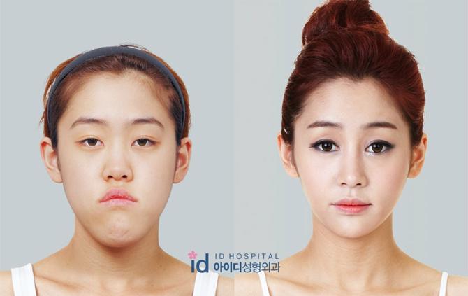 Asian on sale plastic surgery