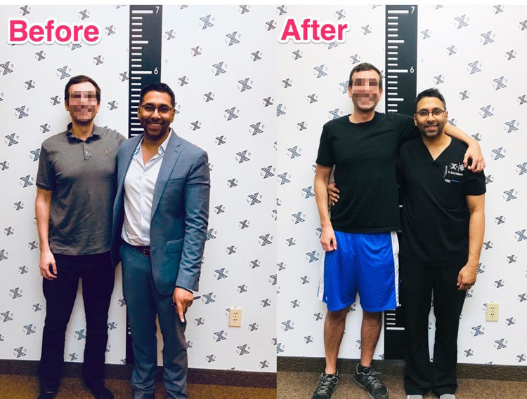 LimbExtending Surgery Is Apparently Popular Among Men Wanting to Be Taller