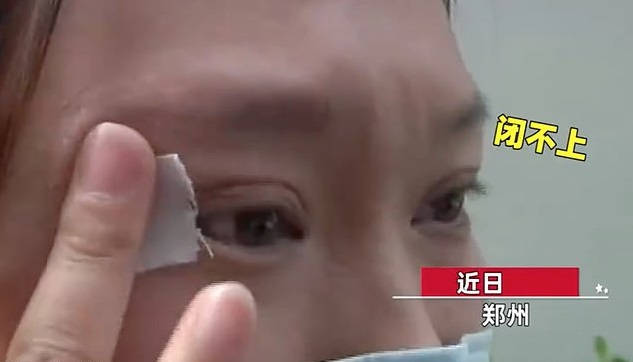 Botched double 2025 eyelid surgery