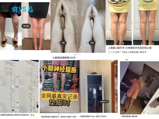 Disturbing Beauty Trend Sees Girls Having Leg Nerves Severed for