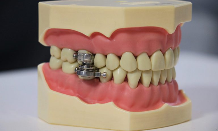 Weight Loss Device Works by Preventing Wearers From ...