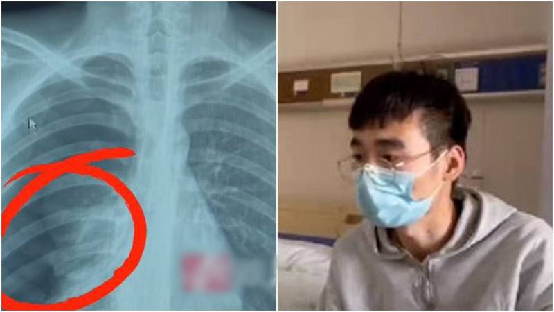 Man Suffers Collapsed Lung by Singing His Heart Out During Karaoke