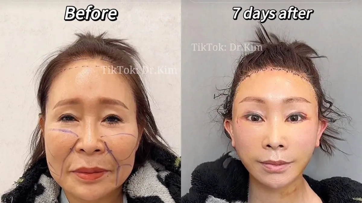 TikTok Plastic Surgeon Goes Viral for Uncanny Before-And-After Videos