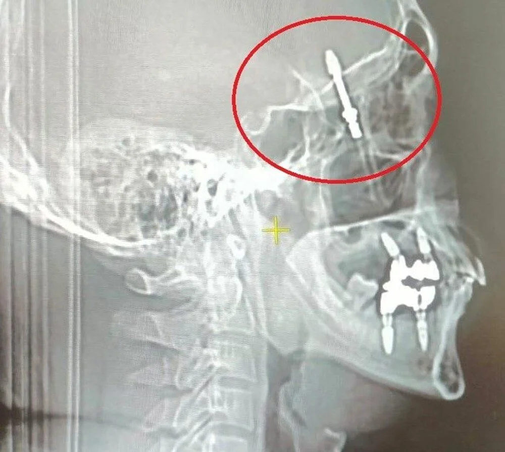 Man Lucky to Be Alive After Dentist Pushes Implant Screw into His Brain Cavity - Vimarsana News