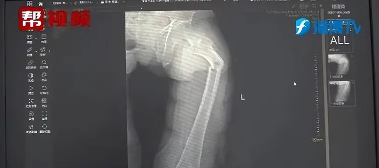35-Year-Old Man Breaks Hardest Bone in the Human Body While Coughing