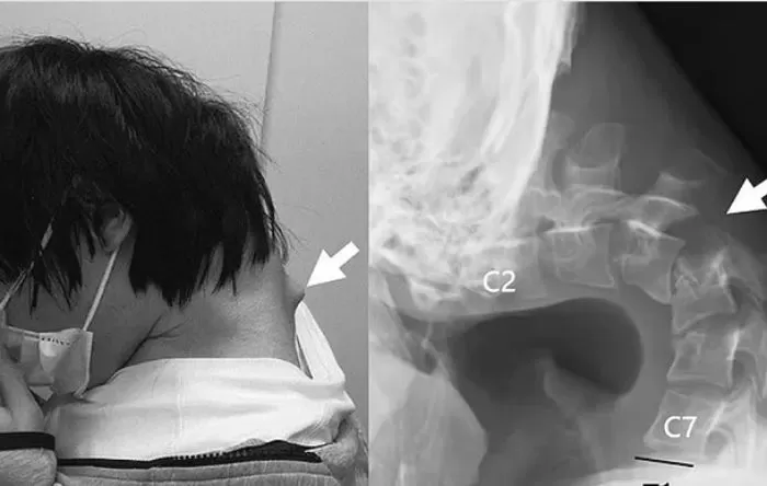 25-Year-Old Man Develops ‘Dropping Head Syndrome’ by Looking at His Phone Too Much