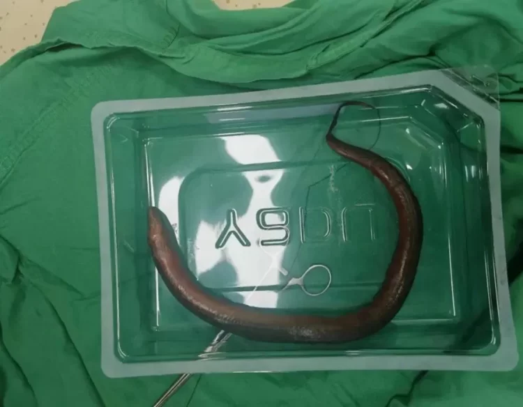 Doctors Find Live Eel Swimming in Man’s Abdominal Cavity