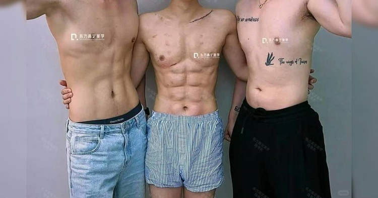 hyaluronic-8-pack3 Homem gasta US$ 560 mil em injeções de ácido hialurônico para desenvolver abdominais falsos de 8 unidades