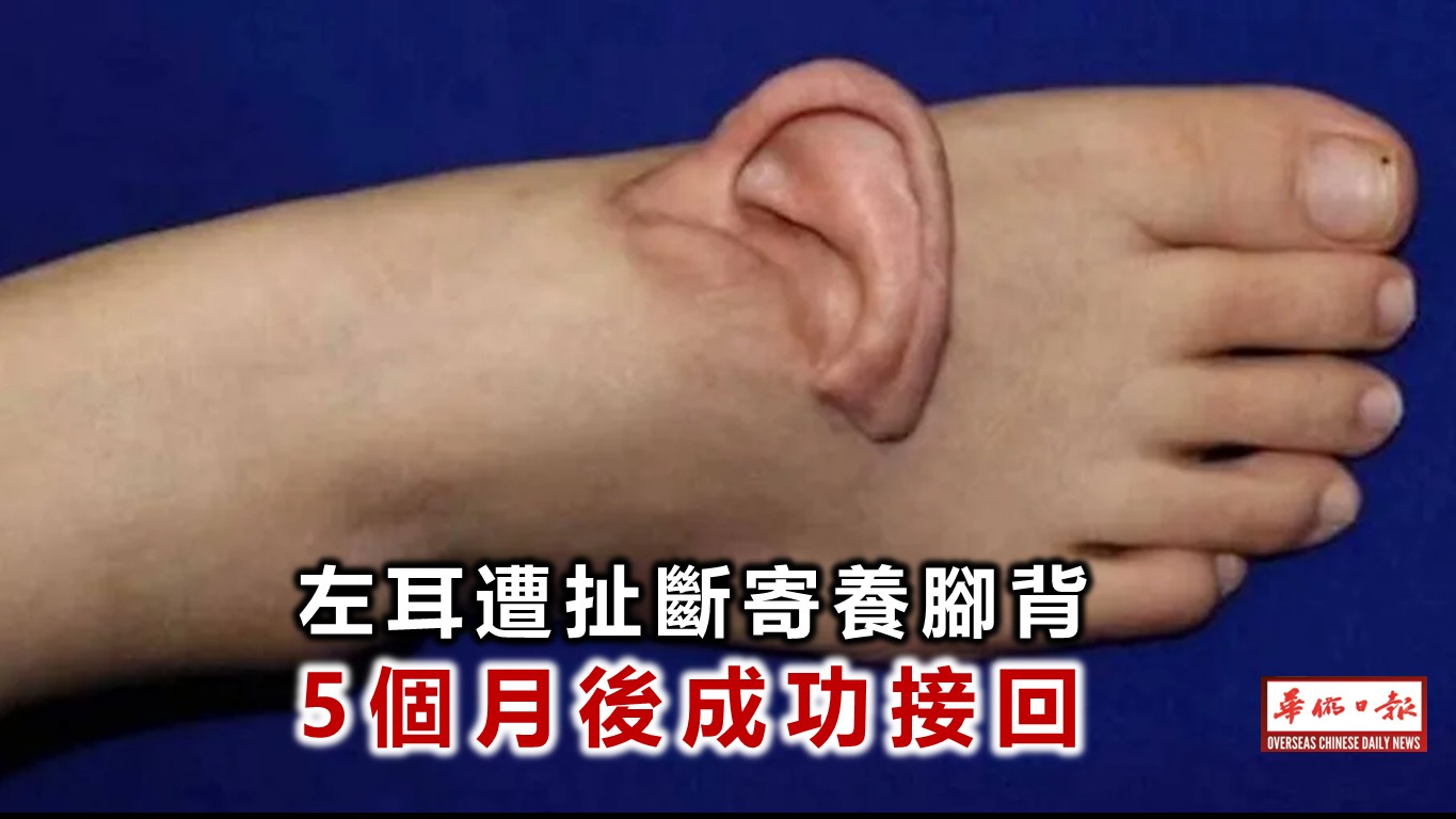 Woman “Wears” Severed Ear on Her Foot for Five Months Before Reattachment