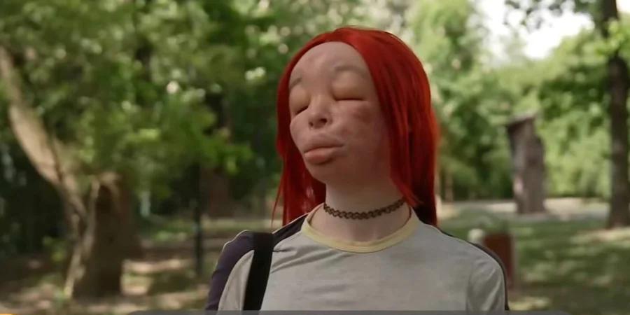 Young Woman Injects Uncertified Silicone into Her Face Every Day with Disastrous Consequences