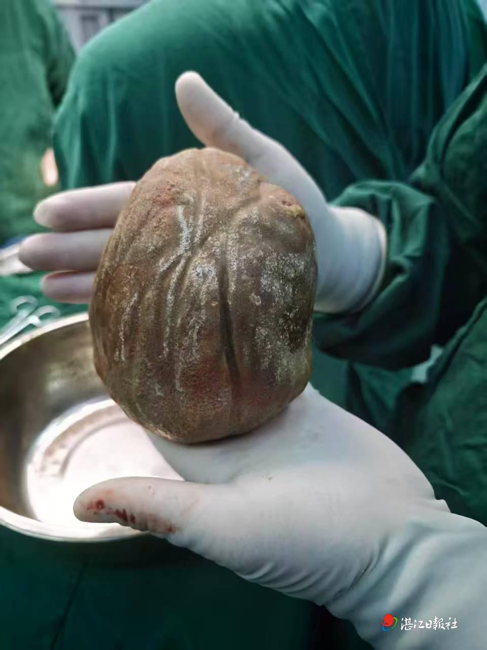 56-Year-Old Man Has 3-Pound Stone Removed from His Bladder