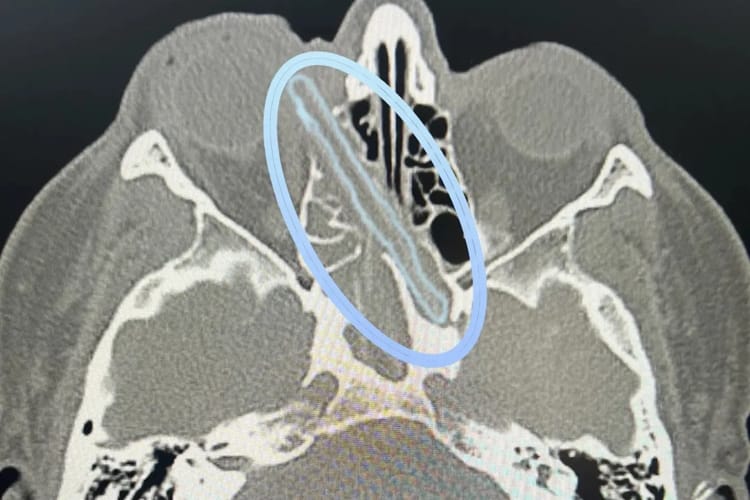 Man Lives with 5-Inch Wooden Branch in Eye Socket for a Year and Half Without Knowing It