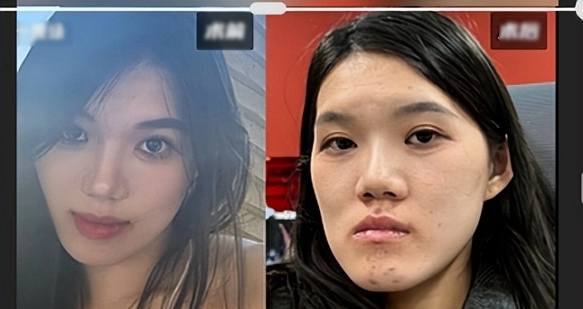 Woman Asks Cosmetic Surgeon for Jaw Micro-Correction, Ends Up with Major Facial Deformation