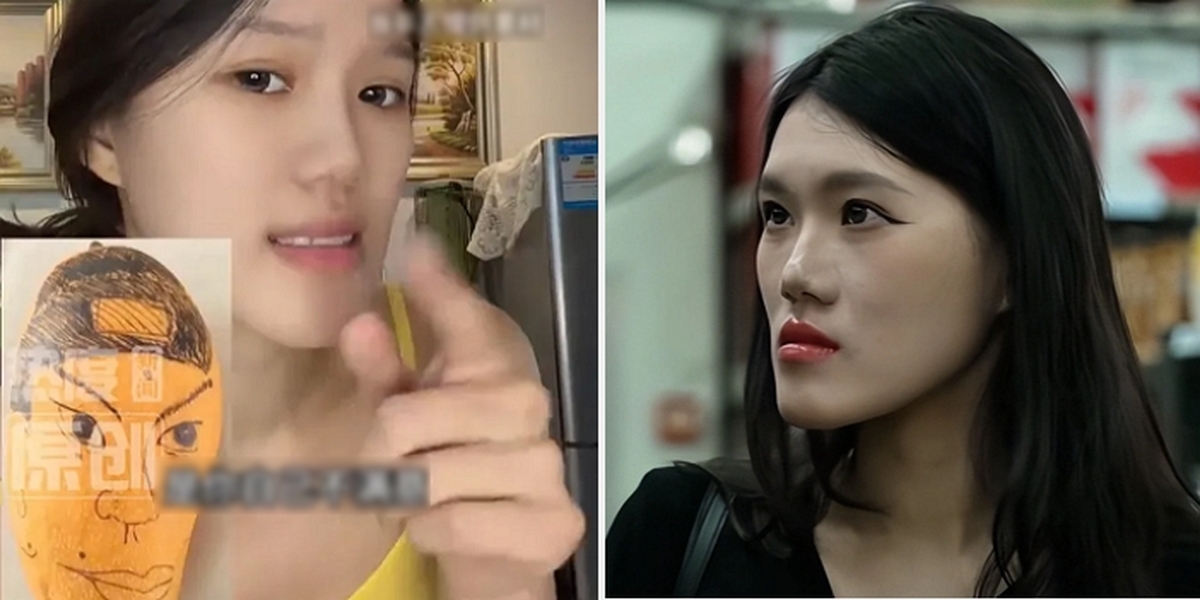 Woman Asks Cosmetic Surgeon for Jaw Micro-Correction, Ends Up with Major Facial Deformation